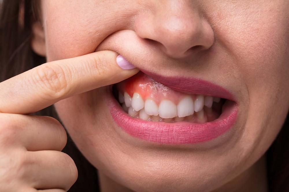 Gum Disease: Signs, Treatment, and Prevention