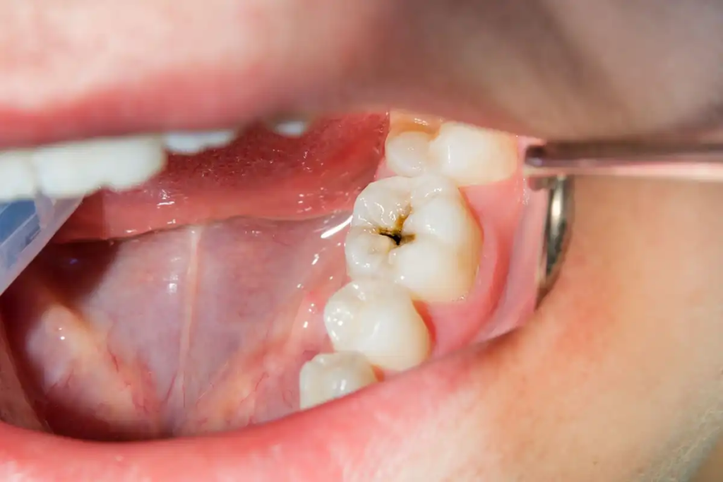 Understanding Tooth Decay: Causes, Symptoms, and Prevention