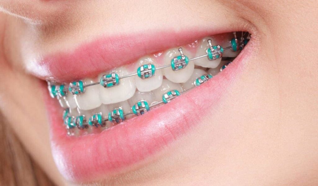 How to Maintain Your Oral Health While Wearing Braces