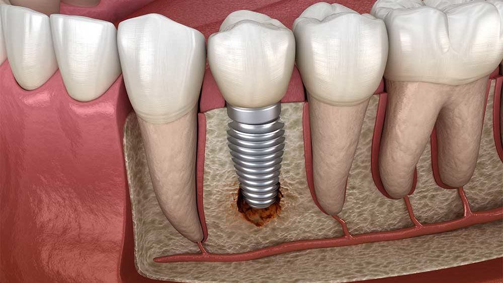 Dental Implants: A Permanent Solution for Missing Teeth