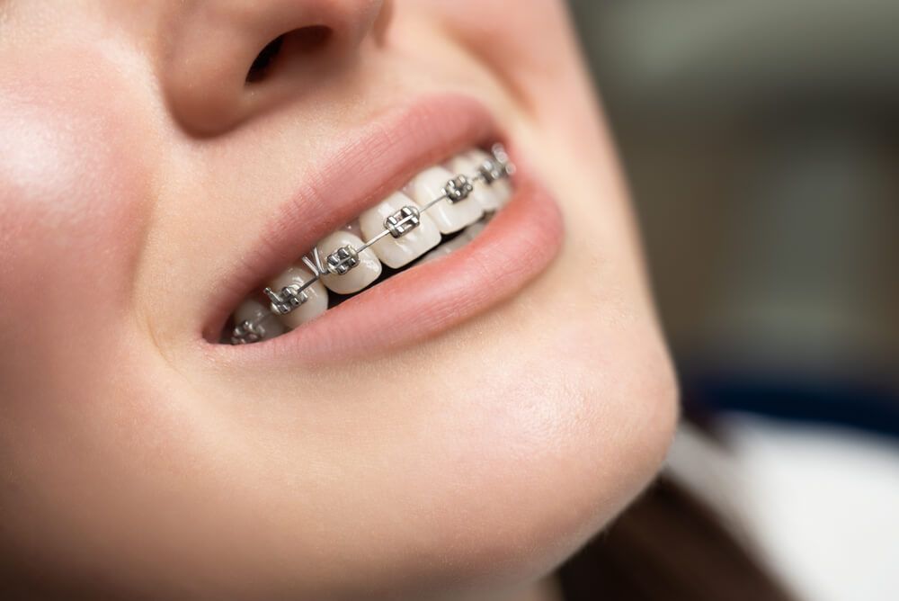 Orthodontic Options for Straightening Your Smile